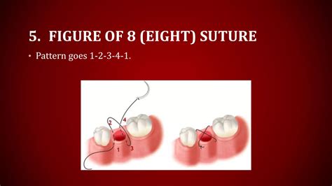 Suturing and its technique | PPTX