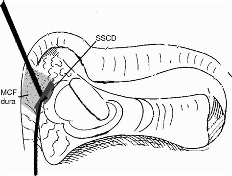 Transmastoid repair of superior semicircular canal dehiscence | The Journal of Laryngology ...