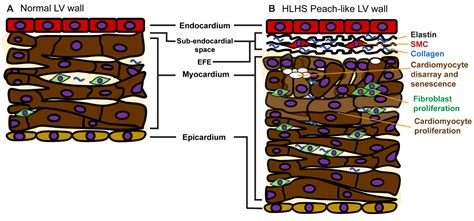 The Left Ventricular Myocardium in Hypoplastic Left Heart Syndrome
