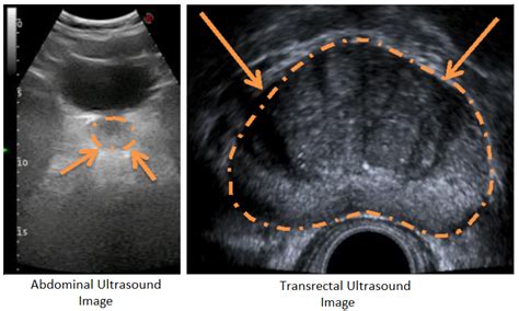 Prostate Anatomy Ultrasound
