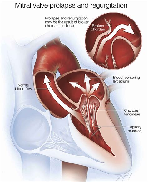 Mitral valve regurgitation causes, symptoms, diagnosis, treatment ...
