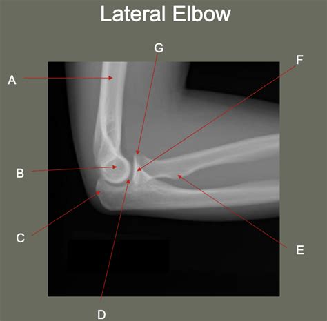 Image result for Elbow Contralateral