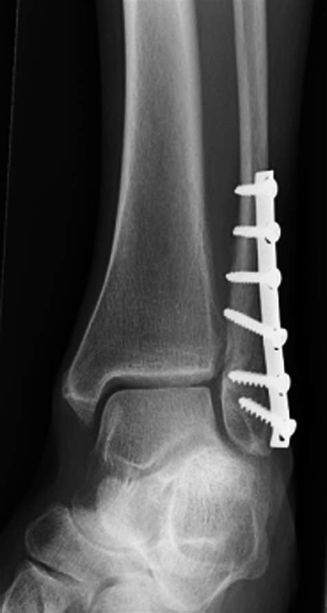 Painful Metalware - Ankle, Foot and Orthotic Centre
