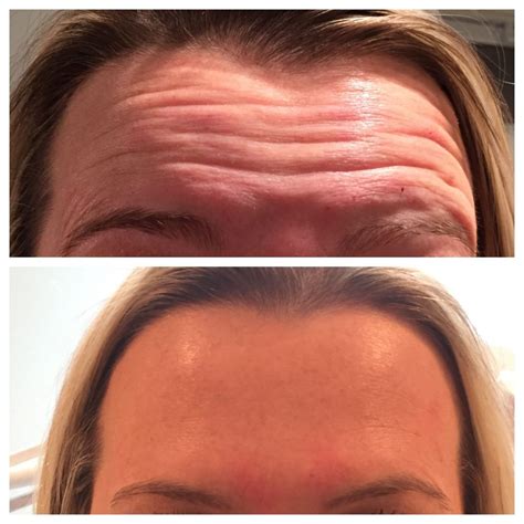 Botox Injections | Nonsurgical Anti-Aging in Plymouth, MA | Fresh Medical Aesthetics