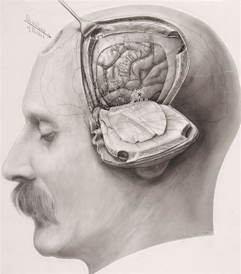 Burr Holes and Bone Flaps | The Neurosurgical Atlas
