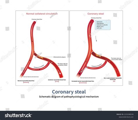 89 Collateral Circulation Images, Stock Photos & Vectors | Shutterstock
