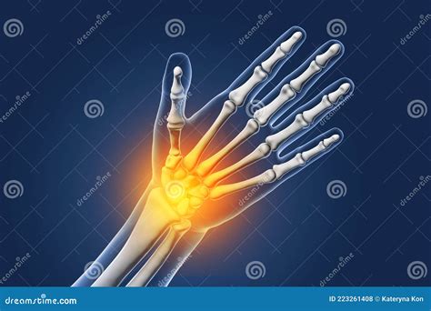 Painful Hand, Pain in Palm or Wrist Stock Illustration - Illustration of medical, computer ...