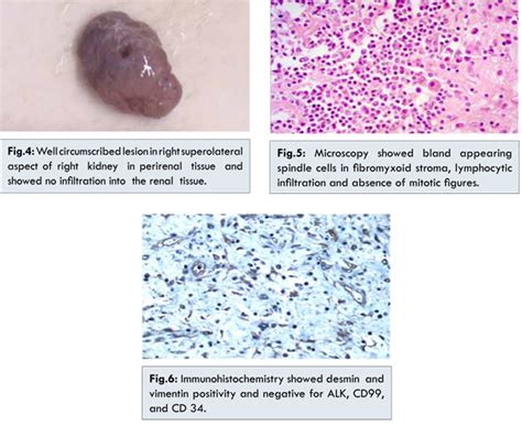 Inflammatory Pseudotumor of Perirenal Soft Tissue