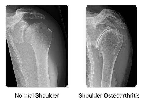 Shoulder Arthritis Treatment in Raleigh