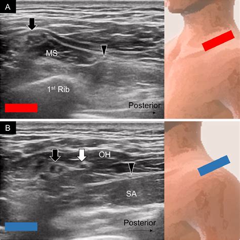 Letter to Editor on “Proximal vs Distal Approach of Ultrasound-guided ...