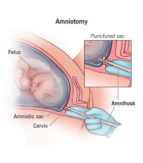 📌 NCLEX Topic: Amniotomy (Artificial Rupture of Membranes – AROM ...