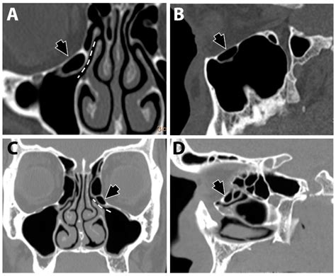 The Associations between the Maxillary Sinus Volume, Infraorbital ...