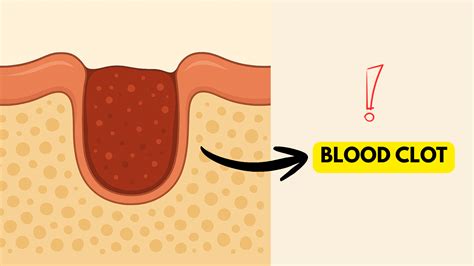 What does a blood clot after tooth extraction look like?