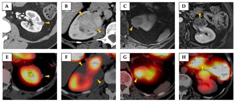 Potential of Metabolic MRI to Address Unmet Clinical Needs in Localised ...