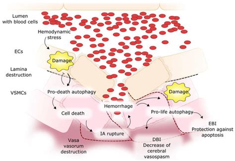 NF-κB-Mediated Inflammation in the Pathogenesis of Intracranial Aneurysm and Subarachnoid ...