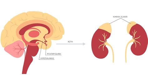 Primary vs. Secondary Adrenal Insufficiency