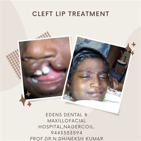 LIP LIFT - Edens dental and face hospital