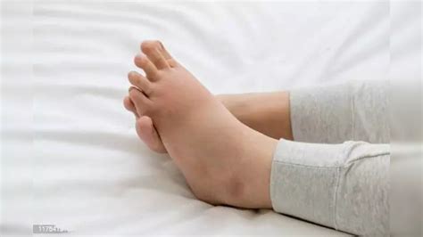 Swelling in feet could point to kidney disorder: Experts | Health News ...