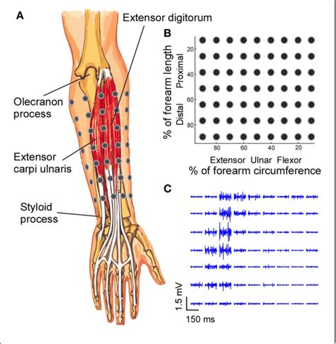 Image result for Extensor Digitorum Communis Surgery