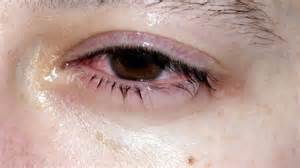 Why do your eyes get crusty in the morning: Causes, treatment, and when ...