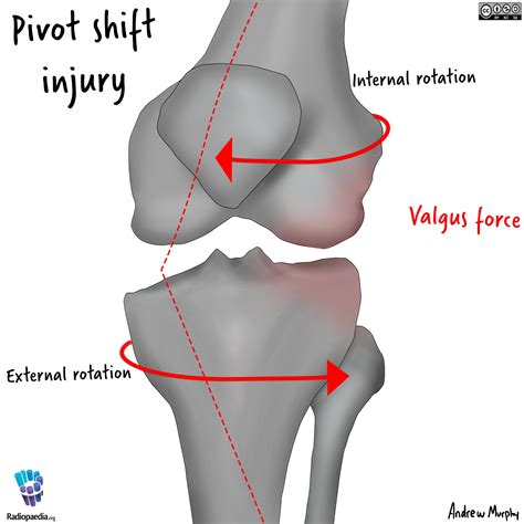 Anterior Cruciate Ligament Tear - MedEd Cases