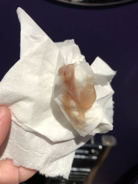 Mucus Plug Pregnancy