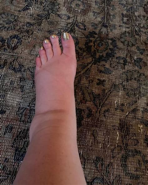 6 Things Your Swollen Feet And Ankles Are Trying To Tell You About Your ...