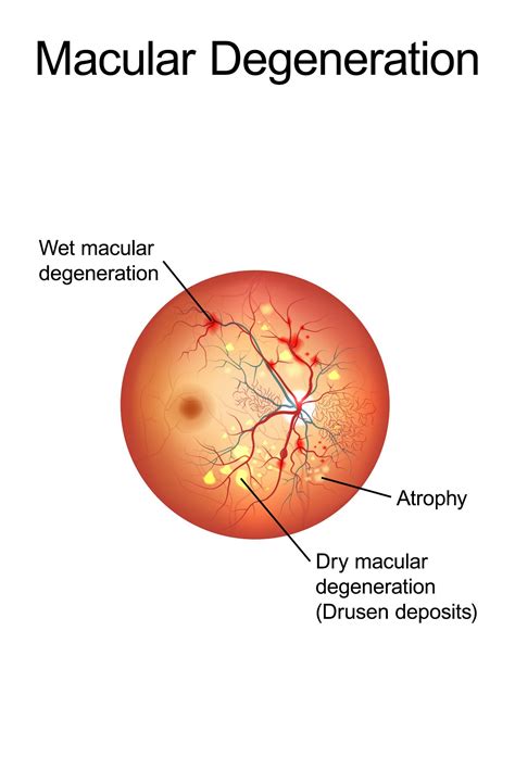 What Is Macular Degeneration Dry at Lisa Cunningham blog