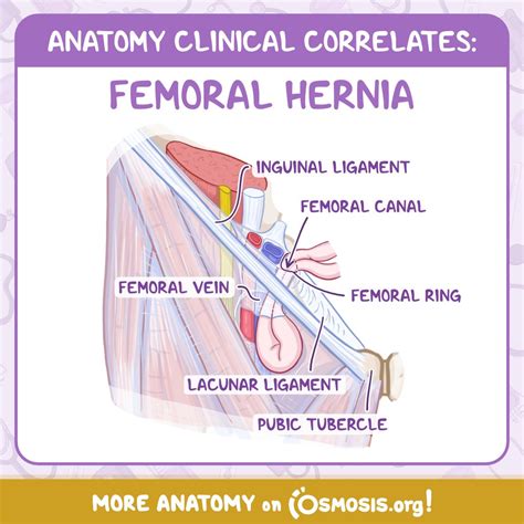 Lacunar Ligament Femoral Hernia Femoral Hernia • #study #study