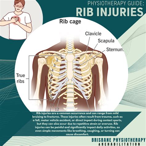 Rib Injuries: Understanding Causes, Symptoms, and Physiotherapy Treatment - Brisbane ...