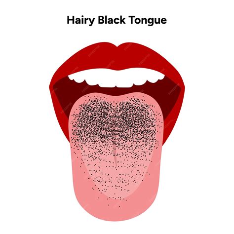 Premium Vector | Hairy black tongue medical illustration