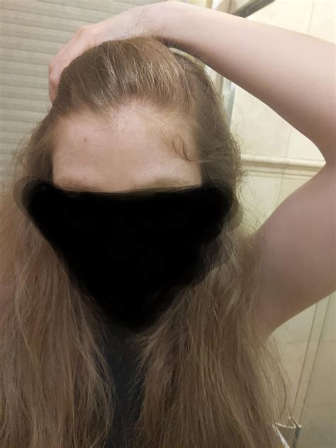 I have Hashi's and chronic iron deficiency -- doctors give conflicting diagnoses on AGA. What's ...