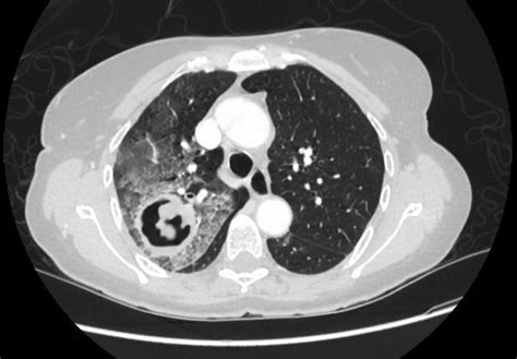 Pulmonary cavitary lesion and haemoptysis: rare aetiology on biopsy | BMJ Case Reports