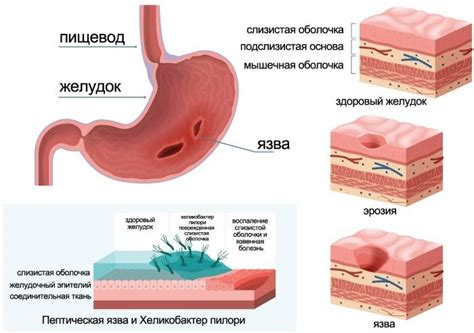 Кто-нибудь вылечил себе гастрит??? - страна мам
