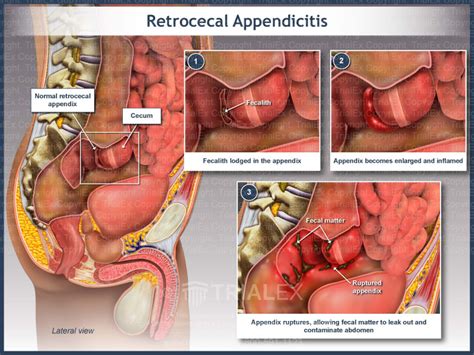 Image result for Appendix Exploded
