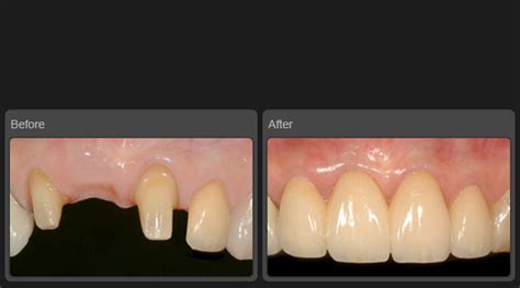 Teeth Replacement at Shwet Dental Clinic and Implant Center Prernatirth ...