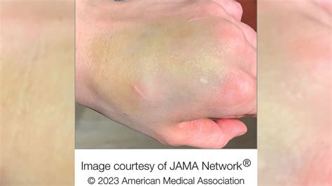 Weird green bruise on woman's hand turns out to be rare tumor | Live Science