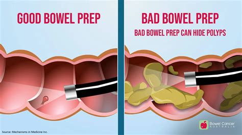 Bowel Prep
