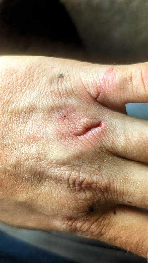 Does my hand need stitches? : r/InjuriesAndWounds