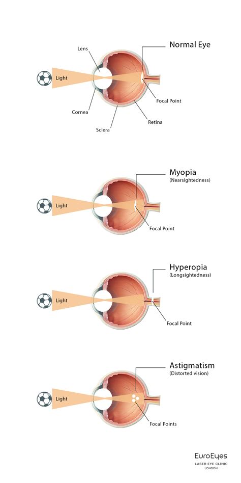 Short Eyesight And Nearsightedness: What Myopia Means For Your Eye Health
