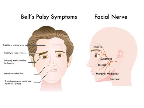 Bell’s Palsy & Acupuncture: Proven Remedy & Quick Recovery