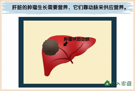 指南解读｜原发性肝癌诊疗规范 (2019年版)|原发性肝癌|肝功能|指南|-健康界