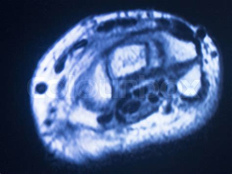 Image result for High-Resolution Hand MRI