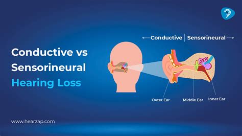Difference between conductive and sensorineural hearing loss explained