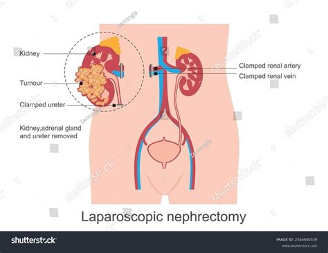 Nephrectomy Surgical Removal Kidney Treats Kidney Stock Vector (Royalty ...