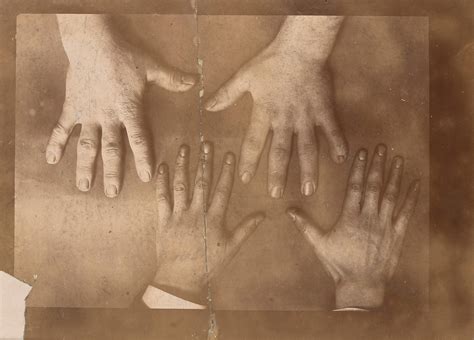 From Dwarf To Giant: The Case Of Adam Rainer | The Vintage News