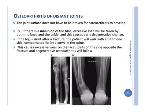 Orthopedic surgery 3rd complications of fractures | PDF