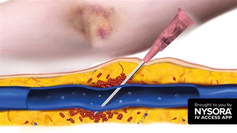 Iv Bruise Back Of Hand