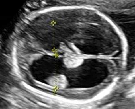 Fetal Ventriculomegaly - American Journal of Obstetrics & Gynecology