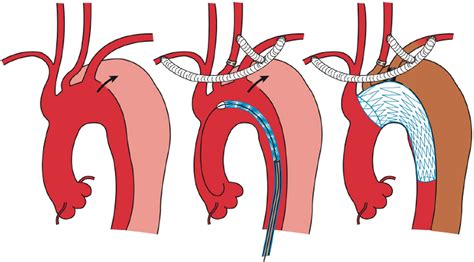 Endovascular Repair of Descending Thoracic Aortic Aneurysms - Advances ...